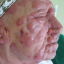 Progression of Mycosis fungoides during 2CdA treatment.